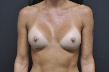 Breast Augmentation Before & After Patient 66
