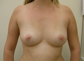Breast Augmentation Before & After Patient 69