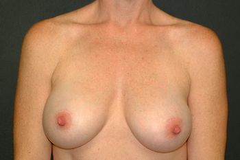 Breast Augmentation Before & After Patient 70