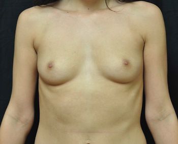 Breast Augmentation Before & After Patient 71