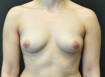 Breast Augmentation Before & After Patient 75
