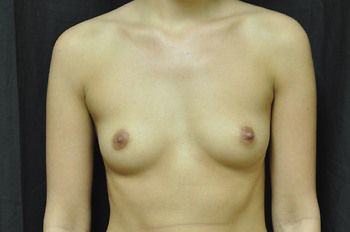 Breast Augmentation Before & After Photo Patient 77 Thumbnail