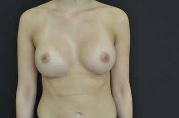Breast Augmentation Before & After Patient 77