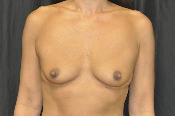 Breast Augmentation Before & After Patient 79