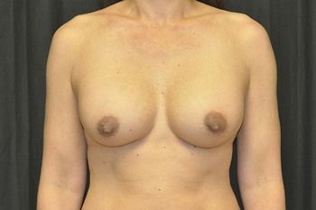Breast Augmentation Before & After Patient 79