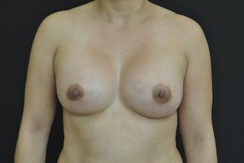 Breast Augmentation Before & After Patient 82