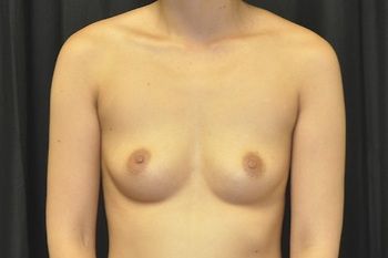 Breast Augmentation Before & After Patient 84