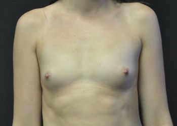 Breast Augmentation Before & After Patient 86