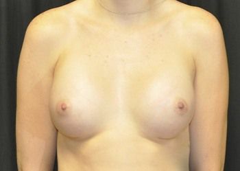 Breast Augmentation Before & After Patient 86