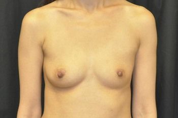 Breast Augmentation Before & After Patient 87