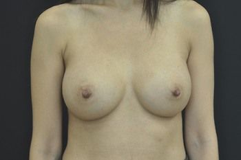 Breast Augmentation Before & After Patient 87