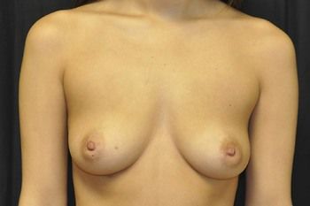 Breast Augmentation Before & After Patient 89