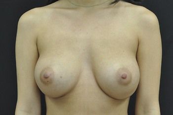 Breast Augmentation Before & After Patient 89