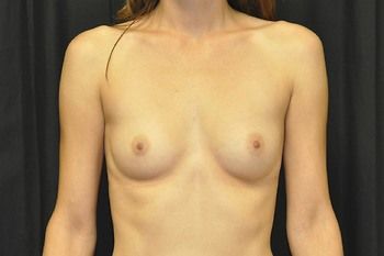 Breast Augmentation Before & After Patient 90