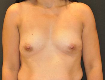 Breast Augmentation Before & After Patient 93