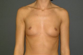 Breast Augmentation Before & After Patient 94
