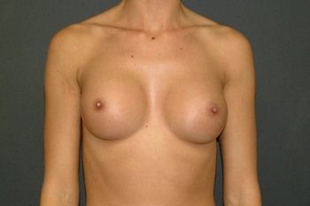 Breast Augmentation Before & After Photo Patient 94 Thumbnail