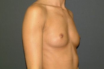 Breast Augmentation Before & After Patient 94