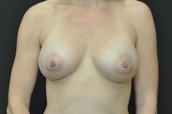 Breast Augmentation Before & After Patient 95