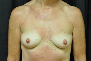 Breast Augmentation Before & After Photo Patient 99 Thumbnail
