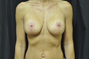 Breast Lift Before & After Patient 02