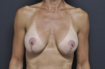 Breast Lift Before & After Patient 03