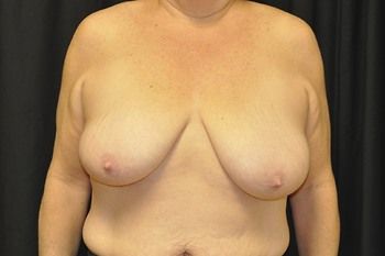 Breast Lift Before & After Patient 05