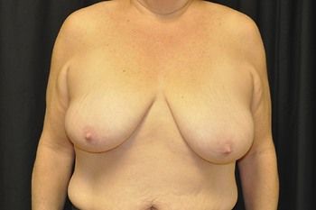 Breast Lift Before & After Photo Patient 05 Thumbnail