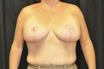 Breast Lift Before & After Photo Patient 05 Thumbnail