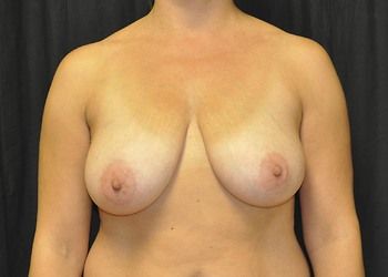 Breast Lift Before & After Patient 06