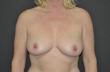 Breast Lift Before & After Patient 11
