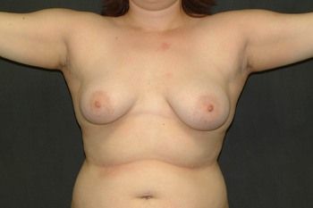 Breast Lift Before & After Patient 15