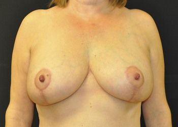 Breast Lift Before & After Patient 21