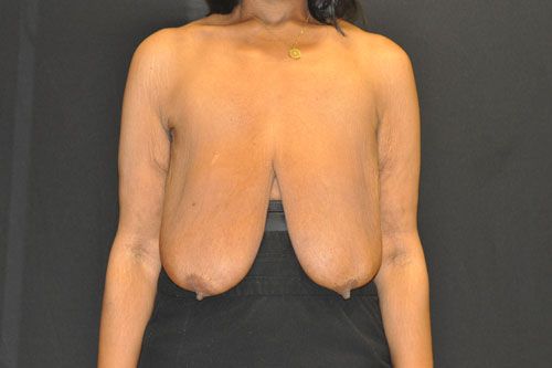 Breast Lift Before & After Patient 27