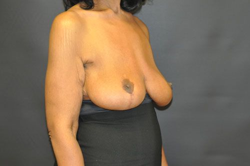 Breast Lift Before & After Patient 27