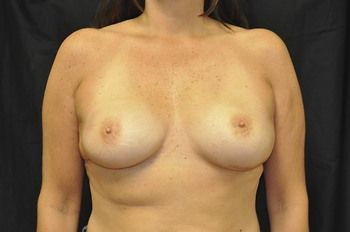 Breast Reconstruction Before & After Photo Patient 02 Thumbnail