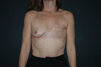 Breast Reconstruction Before & After Photo Patient 07 Thumbnail