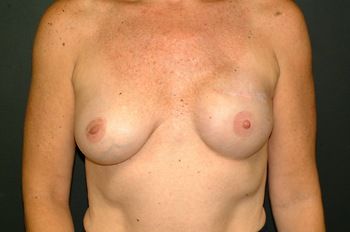 Breast Reconstruction Before & After Photo Patient 07 Thumbnail