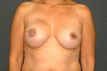 Breast Reconstruction Before & After Patient 12