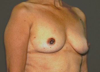 Breast Reconstruction Before & After Photo Patient 12 Thumbnail
