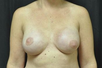 Breast Reconstruction Before & After Photo Patient 15 Thumbnail