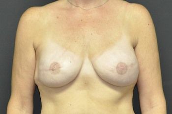 Breast Reconstruction Before & After Photo Patient 18 Thumbnail