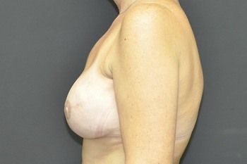 Breast Reconstruction Before & After Photo Patient 18 Thumbnail