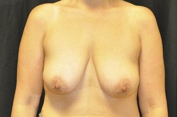 Breast Reconstruction Before & After Photo
