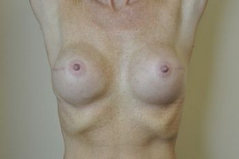 Breast Reconstruction Before & After Photo Patient 21 Thumbnail