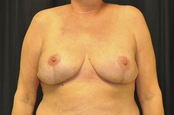 Breast Reconstruction Before & After Photo Patient 22 Thumbnail