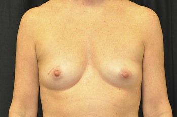 Breast Reconstruction Before & After Photo Patient 23 Thumbnail