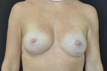 Breast Reconstruction Before & After Photo Patient 23 Thumbnail