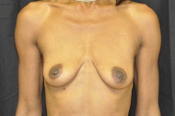 Breast Reconstruction Before & After Photo Patient 24 Thumbnail