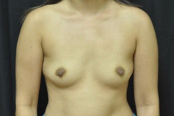 Breast Reconstruction Before & After Photo Patient 27 Thumbnail